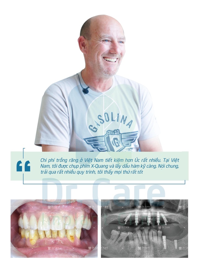 Loại bỏ nỗi lo chi phí với phương pháp trồng răng Implant toàn hàm tiết kiệm - 4 Loại bỏ nỗi lo chi phí với phương pháp trồng răng Implant toàn hàm tiết kiệm - 4