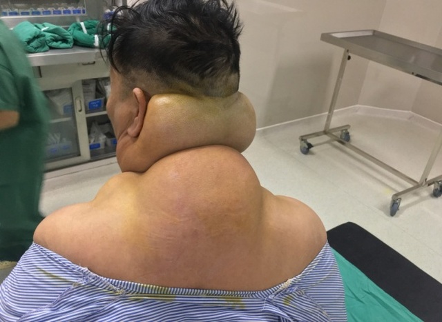 Nghiện rượu nhiều năm, cơ thể người đàn ông biến dạng như người khổng lồ - 2 Nghiện rượu nhiều năm, cơ thể người đàn ông biến dạng như người khổng lồ - 2