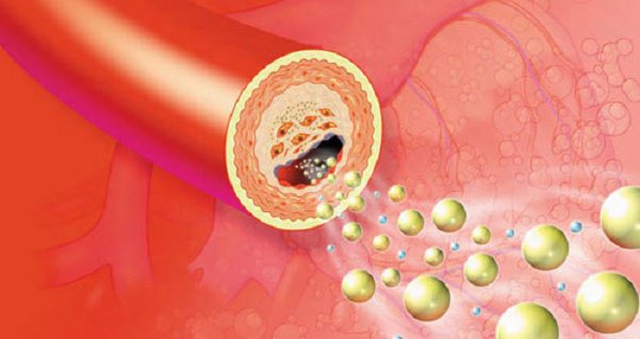 Lipidcleanz - Giải pháp giúp hỗ trợ kiểm soát rối loạn lipid máu - 1 Lipidcleanz - Giải pháp giúp hỗ trợ kiểm soát rối loạn lipid máu - 1