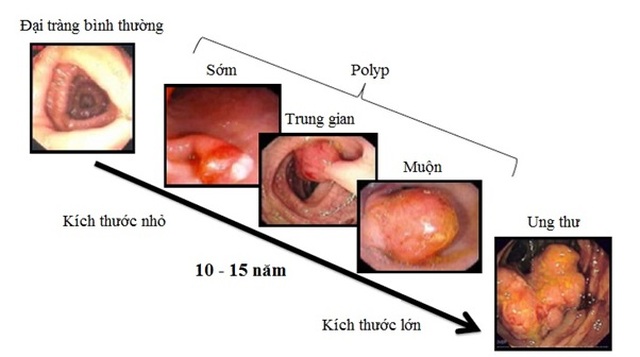 Phát hiện sớm ung thư đại trực tràng - 1 Phát hiện sớm ung thư đại trực tràng - 1