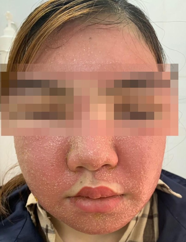 Đắp mặt nạ trắng da, mặt cô gái trẻ sưng vù, nổi mụn - 1 Đắp mặt nạ trắng da, mặt cô gái trẻ sưng vù, nổi mụn - 1