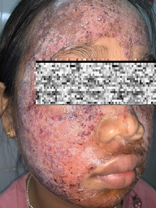 Làm đẹp “siêu tốc” với lọ kem 65 nghìn, da mặt thiếu nữ sưng phù, lở loét - 2 Làm đẹp “siêu tốc” với lọ kem 65 nghìn, da mặt thiếu nữ sưng phù, lở loét - 2