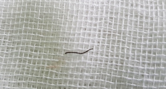 Người đàn ông 46 tuổi bị mảnh sắt đâm xuyên giác mạc - 1 Người đàn ông 46 tuổi bị mảnh sắt đâm xuyên giác mạc - 1