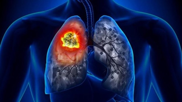 Ứng dụng trí tuệ nhân tạo hỗ trợ chẩn đoán bệnh ung thư phổi - 1