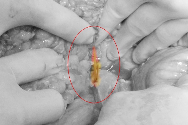 Nuốt 2 cây tăm khi uống bia, người đàn ông gặp tai họa - 1 Nuốt 2 cây tăm khi uống bia, người đàn ông gặp tai họa - 1