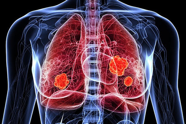 Điều trị ung thư phổi bằng phương pháp ghép phân tử hóa trị - 1