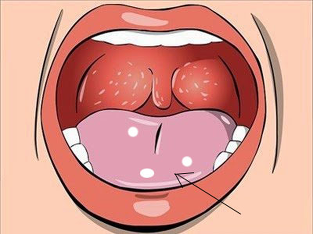 Nhiệt miệng, viêm lợi chữa mãi không khỏi – Nguyên nhân và biện pháp khắc phục hiệu quả - 1