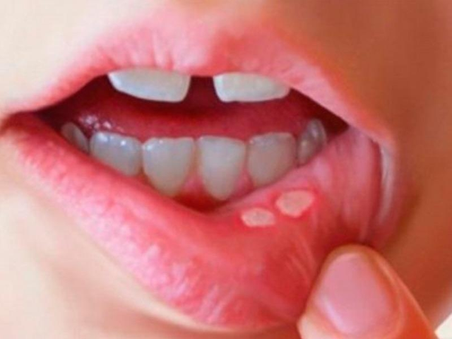 Nhiệt miệng, viêm lợi chữa mãi không khỏi – Nguyên nhân và biện pháp khắc phục hiệu quả - 2