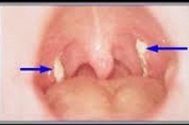 Bé gái 9 tuổi tử vong vì bạch hầu, bệnh nguy hiểm như thế nào? - 2 Bé gái 9 tuổi tử vong vì bạch hầu, bệnh nguy hiểm như thế nào? - 2