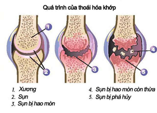 Viêm khớp, thoái hoá khớp có chữa khỏi được không? - 2 Viêm khớp, thoái hoá khớp có chữa khỏi được không? - 2