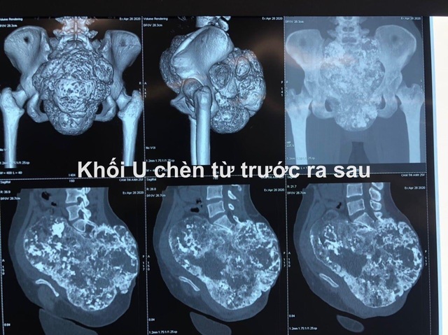Xót thương cô gái dân tộc Thái suốt 10 năm sống chung với khối u khổng lồ - 2 Xót thương cô gái dân tộc Thái suốt 10 năm sống chung với khối u khổng lồ - 2