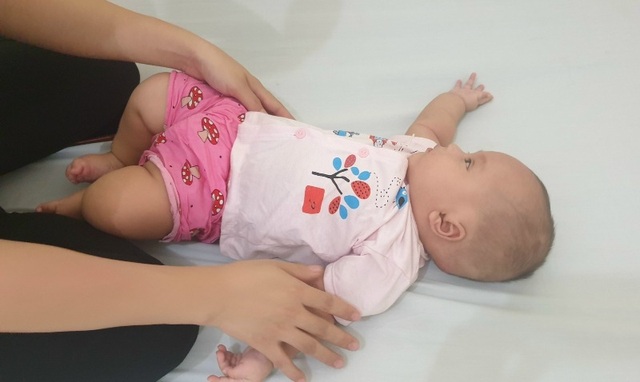 Hoảng hồn khối thoát vị não - màng não to như quả dừa ở bé gái 3 tháng tuổi - 4 Hoảng hồn khối thoát vị não - màng não to như quả dừa ở bé gái 3 tháng tuổi - 4