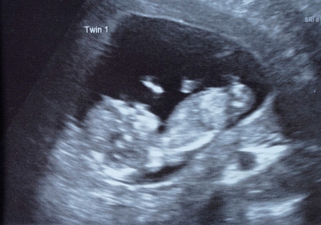 Người phụ nữ mang song thai ở 2 tử cung - Ảnh minh hoạ 2