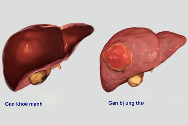 Ung thư sát thủ với nam giới bắt nguồn từ bệnh lý mãn tính - 1 Ung thư sát thủ với nam giới bắt nguồn từ bệnh lý mãn tính - 1