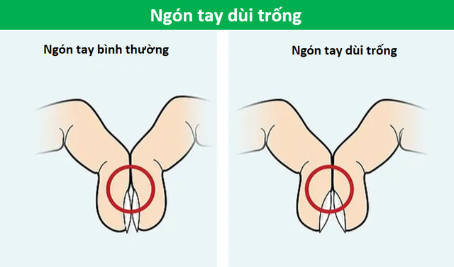 Áp 2 ngón tay vào nhau không thấy khoảng hở: Cảnh giác với bệnh nan y - 6 Áp 2 ngón tay vào nhau không thấy khoảng hở: Cảnh giác với bệnh nan y - 6