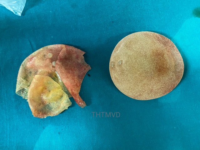 Người phụ nữ vỡ túi ngực không hay biết - 1 Người phụ nữ vỡ túi ngực không hay biết - 1