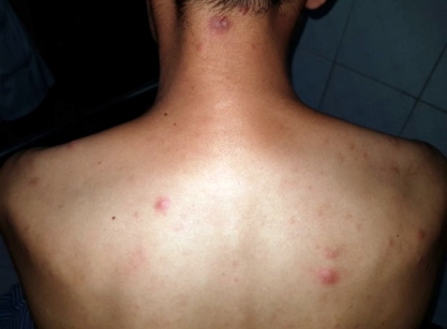 Bệnh hủi “tấn công” một người đàn ông ở Lạng Sơn - 1