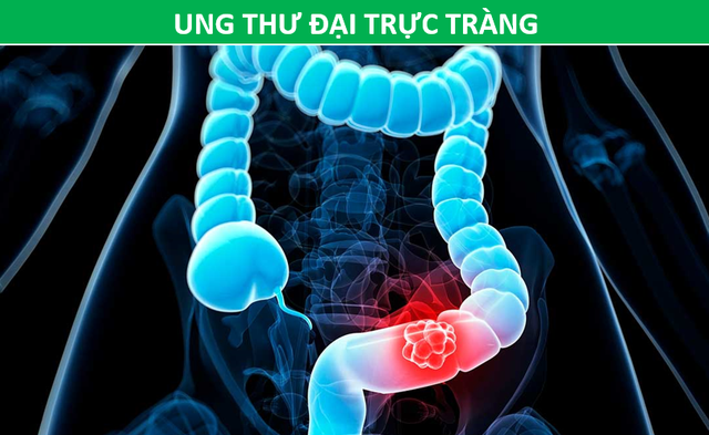 Những phương pháp tầm soát ung thư giúp bạn chủ động trước bệnh tật - 5 Những phương pháp tầm soát ung thư giúp bạn chủ động trước bệnh tật - 5