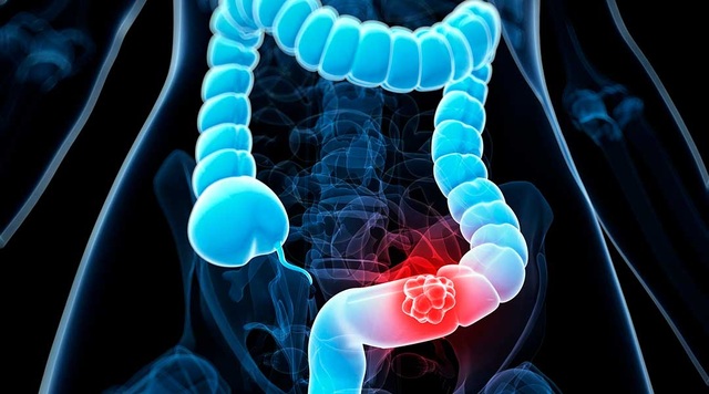 Phát hiện ung thư giai đoạn cuối chỉ sau 2 tháng bị táo bón, sụt cân - 1 Phát hiện ung thư giai đoạn cuối chỉ sau 2 tháng bị táo bón, sụt cân - 1