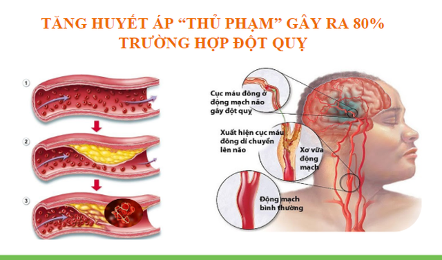 Hội thảo khoa học về bệnh tăng huyết áp và phòng ngừa đột quỵ - 1 Hội thảo khoa học về bệnh tăng huyết áp và phòng ngừa đột quỵ - 1