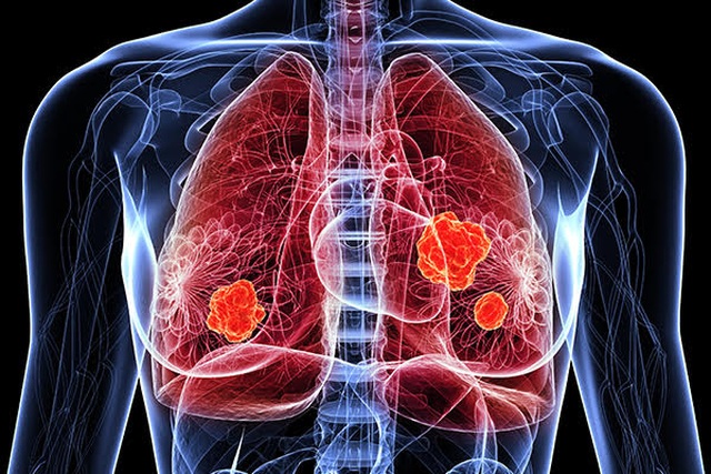 Bệnh ung thư phổi của bạn đang ở giai đoạn nào? - 1