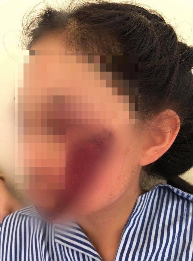 Áo chống nắng cuốn vào bánh xe, nữ sinh ngã chấn thương nghiêm trọng - 1 Áo chống nắng cuốn vào bánh xe, nữ sinh ngã chấn thương nghiêm trọng - 1