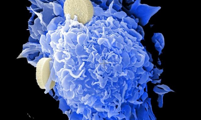 Phát hiện loại chất béo có thể tiêu diệt tế bào ung thư - 1