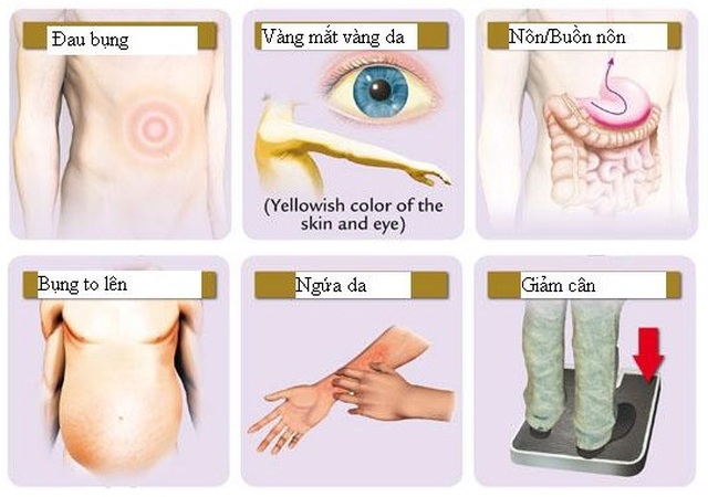Dấu hiệu sớm cảnh báo ung thư gan - 1 Dấu hiệu sớm cảnh báo ung thư gan - 1