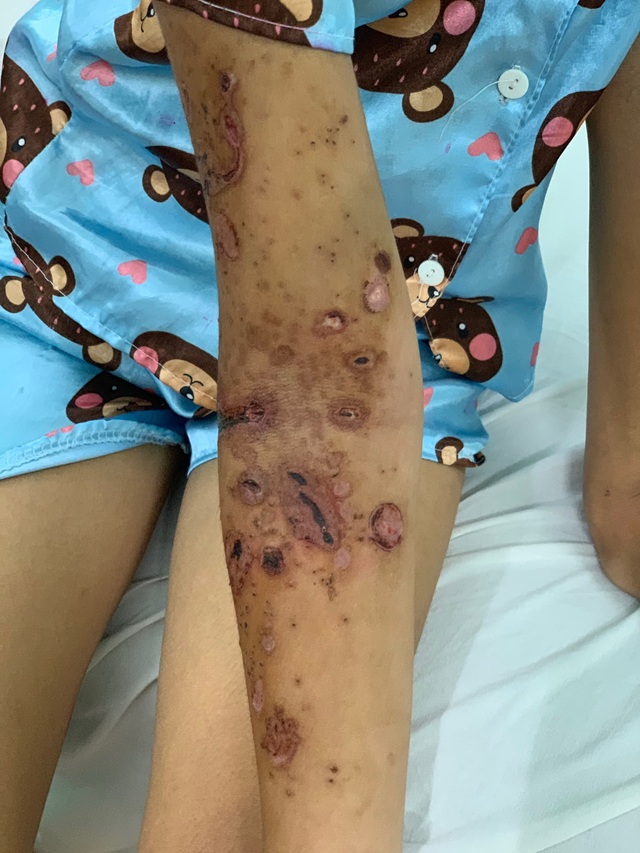 Bị sứa biển tấn công, bé gái trúng độc bỏng rộp cánh tay - 2 Bị sứa biển tấn công, bé gái trúng độc bỏng rộp cánh tay - 2