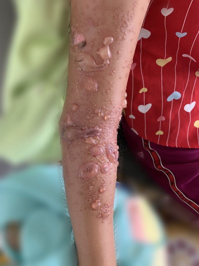 Bị sứa biển tấn công, bé gái trúng độc bỏng rộp cánh tay - 1 Bị sứa biển tấn công, bé gái trúng độc bỏng rộp cánh tay - 1