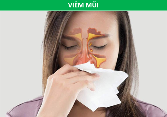 Cảnh giác với nhiều bệnh nguy hiểm khi mắt xuất hiện quầng thâm - 4 Cảnh giác với nhiều bệnh nguy hiểm khi mắt xuất hiện quầng thâm - 4