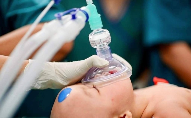 Cuộc đại phẫu cân não tách cặp song sinh dính nhau phức tạp đã thành công - 4 Cuộc đại phẫu cân não tách cặp song sinh dính nhau phức tạp đã thành công - 4