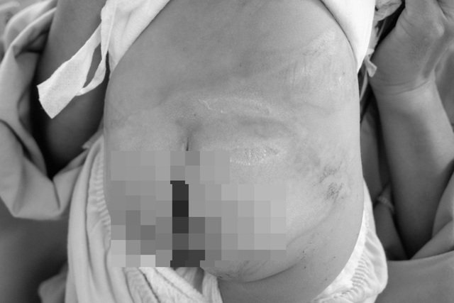 Ngồi vào nồi canh, bé trai bỏng nặng vùng mông và cơ quan sinh dục - 3 Ngồi vào nồi canh, bé trai bỏng nặng vùng mông và cơ quan sinh dục - 3