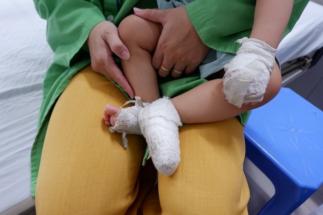 Ngồi vào nồi canh, bé trai bỏng nặng vùng mông và cơ quan sinh dục - 4 Ngồi vào nồi canh, bé trai bỏng nặng vùng mông và cơ quan sinh dục - 4