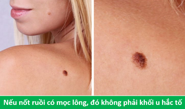 Những sự thật về ung thư sẽ giúp bạn thở phào - 1 Những sự thật về ung thư sẽ giúp bạn thở phào - 1