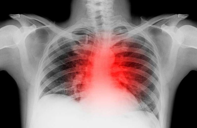 Ba phần tư bệnh nhân COVID-19 tổn thương tim nhiều tháng sau khi khỏi bệnh - 1 Ba phần tư bệnh nhân COVID-19 tổn thương tim nhiều tháng sau khi khỏi bệnh - 1