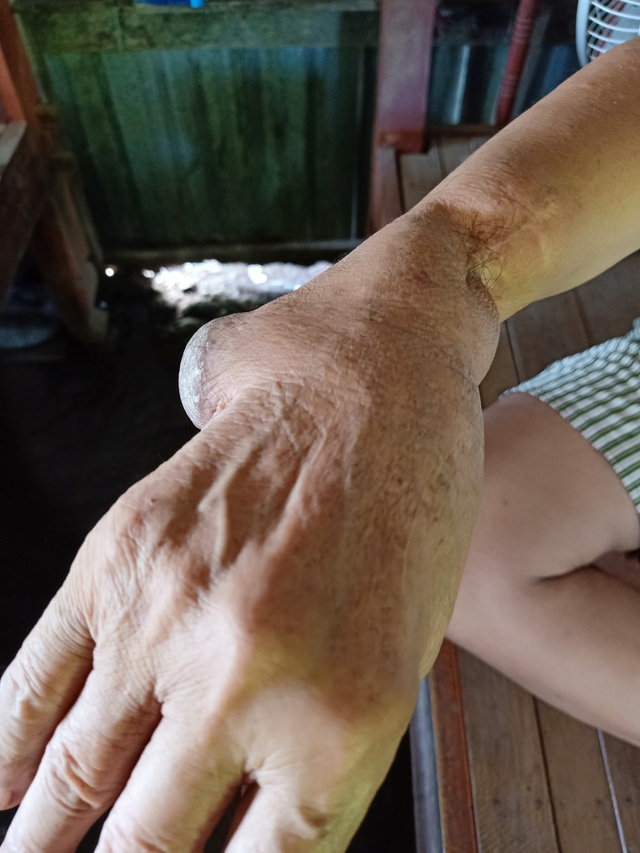 Hoàn cảnh đau nhói của người cựu binh với nhiều vết thương chiến tranh - 3 Hoàn cảnh đau nhói của người cựu binh với nhiều vết thương chiến tranh - 3