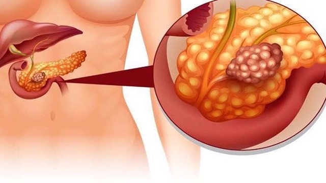 Loại ung thư nguy hiểm bệnh nhân tiểu đường cần đặc biệt cảnh giác - 7 Loại ung thư nguy hiểm bệnh nhân tiểu đường cần đặc biệt cảnh giác - 7