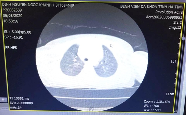 Cháu bé 3 tuổi nuốt nút điều khiển tivi vào khí quản - 1 Cháu bé 3 tuổi nuốt nút điều khiển tivi vào khí quản - 1