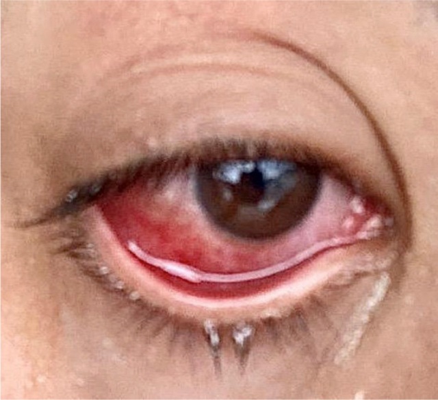 Mắt đỏ có thể là dấu hiệu nhiễm virus corona - 2 Mắt đỏ có thể là dấu hiệu nhiễm virus corona - 2