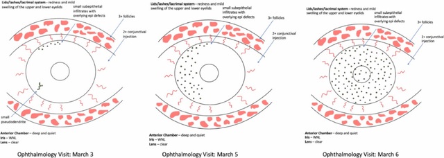 Mắt đỏ có thể là dấu hiệu nhiễm virus corona - 3 Mắt đỏ có thể là dấu hiệu nhiễm virus corona - 3