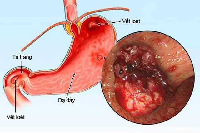 Bách Vị An - tốt cho người viêm loét dạ dày, tá tràng - 1 Bách Vị An - tốt cho người viêm loét dạ dày, tá tràng - 1