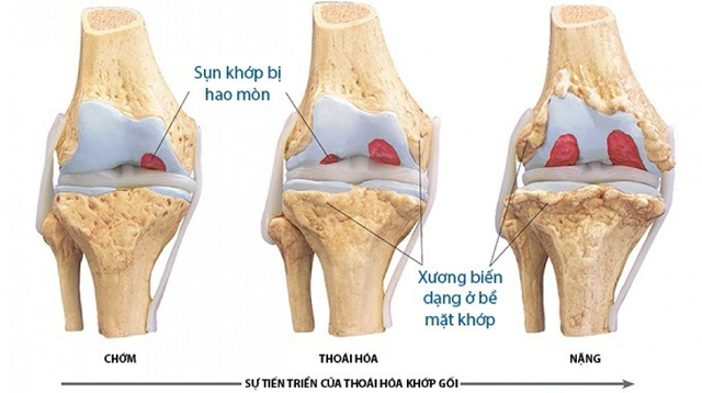 Xương khớp Ngọc Linh sản phẩm dành cho người thoái hóa khớp - 1 Xương khớp Ngọc Linh sản phẩm dành cho người thoái hóa khớp - 1
