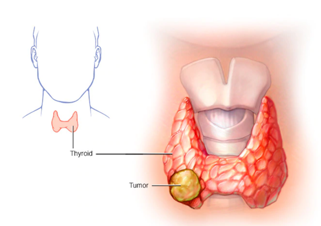 Sờ thấy hạch ở cổ, có phải đã mắc ung thư tuyến giáp? - 1