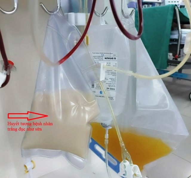 Bệnh nhân bị viêm tụy cấp, huyết tương trắng như sữa - 1 Bệnh nhân bị viêm tụy cấp, huyết tương trắng như sữa - 1