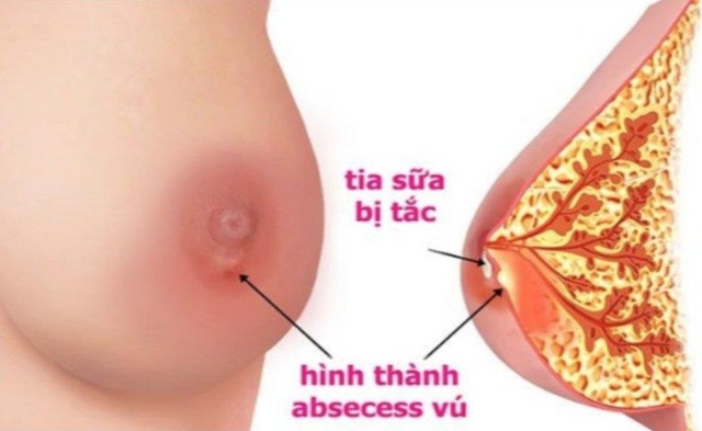 Giải pháp hỗ trợ tình trạng tắc tia sữa, ít sữa nhờ cốm lợi sữa - 2 Giải pháp hỗ trợ tình trạng tắc tia sữa, ít sữa nhờ cốm lợi sữa - 2