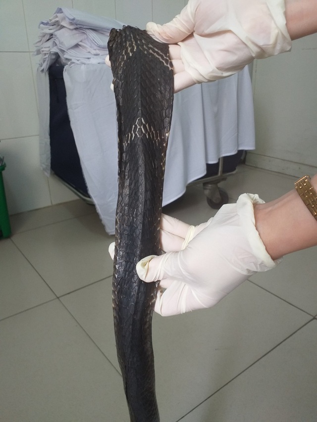 Thêm một nạn nhân bị rắn hổ chúa cắn suýt mất mạng - 3 Thêm một nạn nhân bị rắn hổ chúa cắn suýt mất mạng - 3