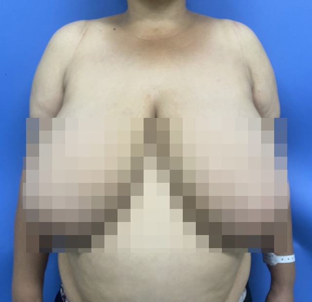 Nỗi khổ của người phụ nữ gần 3 thập kỷ chung sống với bộ ngực khổng lồ - 1