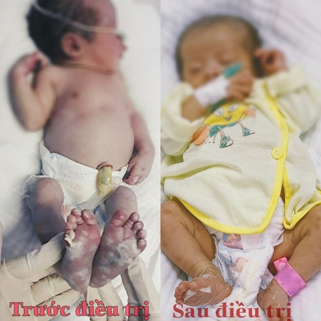 Bé sơ sinh phồng rộp, viêm nhiễm tay chân do lây bệnh giang mai từ mẹ - 1 Bé sơ sinh phồng rộp, viêm nhiễm tay chân do lây bệnh giang mai từ mẹ - 1