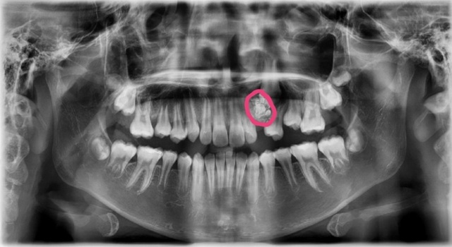 Lý do bất ngờ khiến bé gái 12 tuổi chưa mọc răng nanh | Báo Dân trí